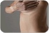 C�ncer de �tero: obesidade e distribui��o de gordura pelo corpo aumentam o risco de c�ncer endometrial